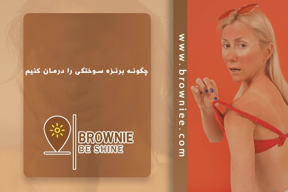 چگونه برنزه سوختگی را درمان کنیم